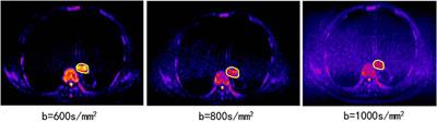 Prognostic Value of Texture Analysis Based on Pretreatment DWI-Weighted MRI for Esophageal Squamous Cell Carcinoma Patients Treated With Concurrent Chemo-Radiotherapy